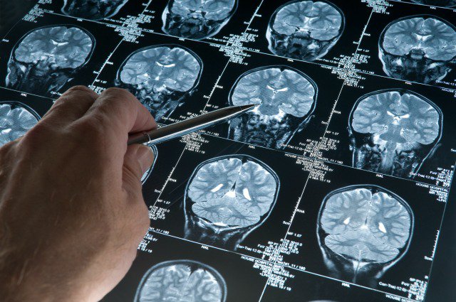 neuroscientist-shows-fasting-brain-big-pharma-wont-study